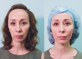 Aged woman doing mesothreads and Thread Lifting, Cosmetology. Cosmetic procedure to eliminate signs of aging. Beauty Face, Facial contour, plastic surgery concept for Age 40-50 years