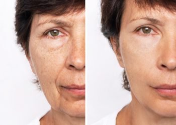 aged-young-woman-s-face-process-aging-rejuvenation-result-plastic-surgery
