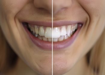 A woman's teeth with one being clean and the other being dirty. The clean teeth are white and shiny, while the dirty teeth are yellow and stained