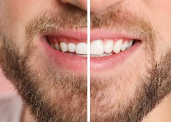 Young man before and after gingivoplasty procedure, closeup